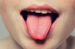 سوختگی زبان